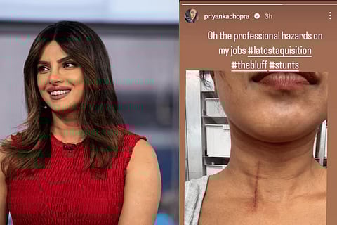 Priyanka Chopra shares injury update from the stunts of ‘The Bluff’