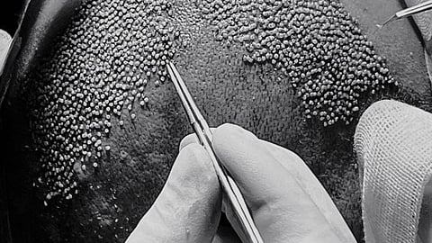 Why is baldness more common in males than females