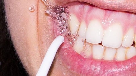 Waterfloss versus regular floss