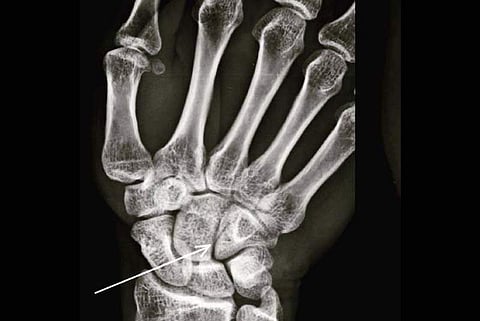 Farhan Akhtar suffers 'boxing injury' (Source: IANS)