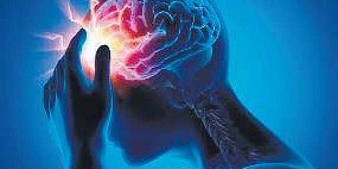 Representational image of stroke