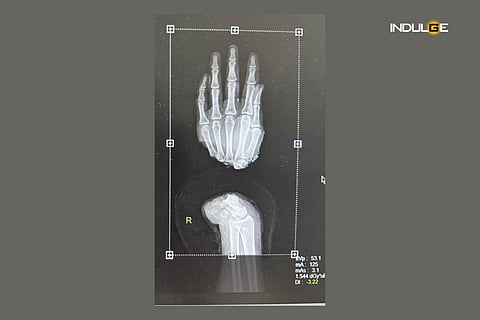 Delhi-based doctors successfully transplant hand of a daily wage labourer