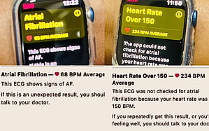 Apple Watch saves Delhi woman's life by alerting abnormal heart rhythm