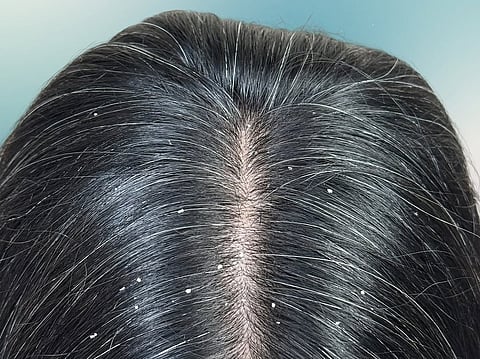 Get rid of dandruff this winter with these home remedies