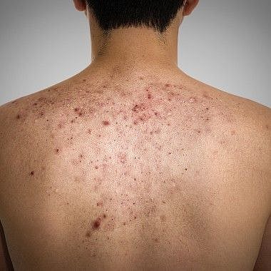What causes back acne in males