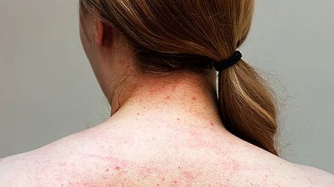 What causes back acne in females
