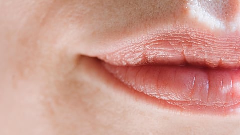 How to treat cracked corners of the mouth? 