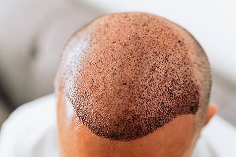 Hair transplant dilemma: When is the correct time to do it?