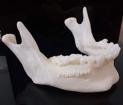 3D printed jaw helps oral cancer survivor (Photo: IANS)