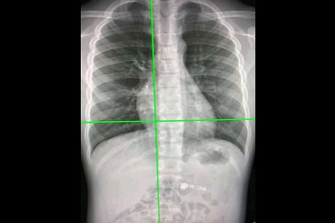 New AI tool can detect Covid infection from chest X-rays 98% accuracy